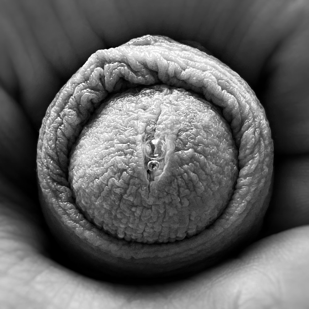 Macro of contracted penile glans surrounded by folded foreskin